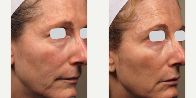 ResurFX before and after photo
