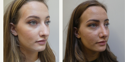 Rhinoplasty before and after photo