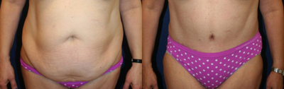 Tummy Tuck before and after photo
