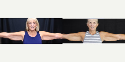 Vaser Liposuction before and after photo