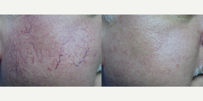 YAG Laser before and after photo