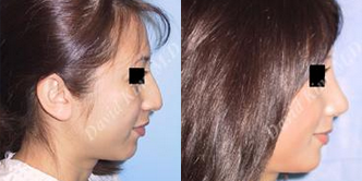 Asian Rhinoplasty before and after photo