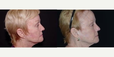 Bellafill before and after photo