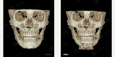 Canthoplasty before and after photo