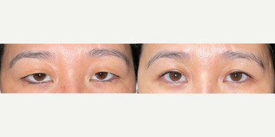 Eyelid Surgery before and after photo