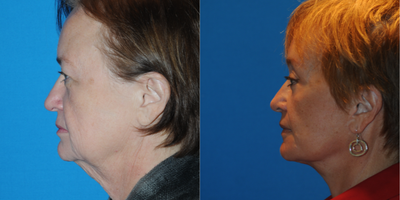 Facelift before and after photo
