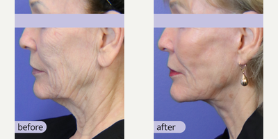 Facial Fat Transfer before and after photo
