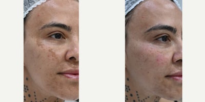 LED Light Therapy before and after photo