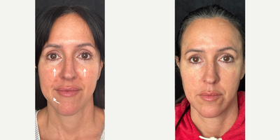 Microneedling before and after photo