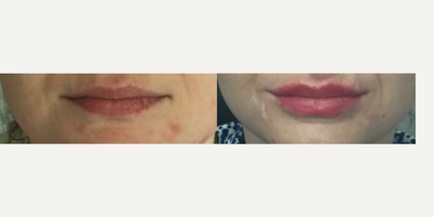 Belotero before and after photo