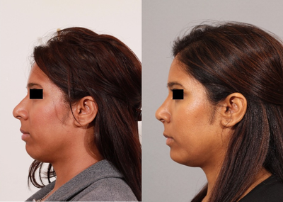 Chin Implant before and after photo