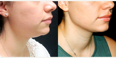 Chin Liposuction before and after photo