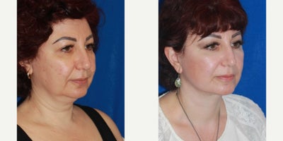 Deep Plane Facelift before and after photo