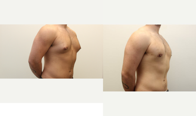 Gynecomastia Surgery before and after photo