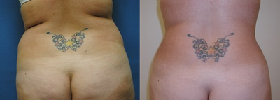 Liposuction before and after photo