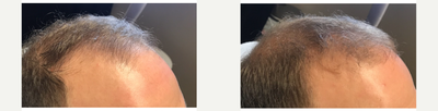 PRP for Hair Loss before and after photo