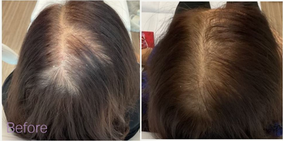 PRP for Hair Loss before and after photo