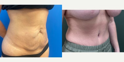Tummy Tuck before and after photo