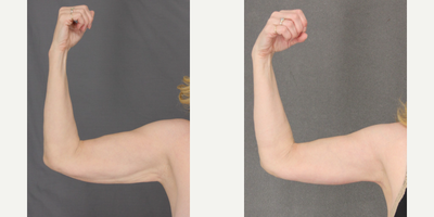 Arm Lift before and after photo