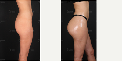 Brazilian Butt Lift before and after photo