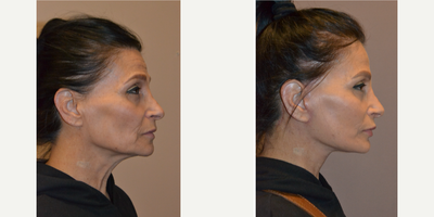 Deep Plane Facelift before and after photo