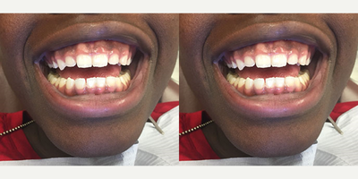 Dental Implants before and after photo