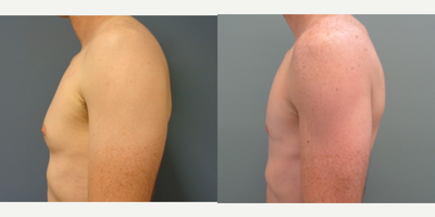 Gynecomastia Surgery before and after photo