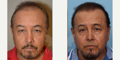 Hair Transplant before and after photo