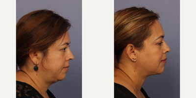 Liposuction before and after photo