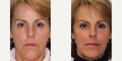 Liquid Facelift before and after photo