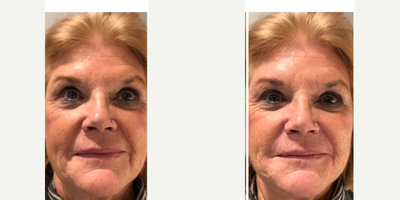Radiesse before and after photo