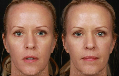 Restylane before and after photo
