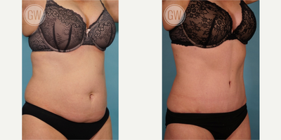 Tummy Tuck before and after photo