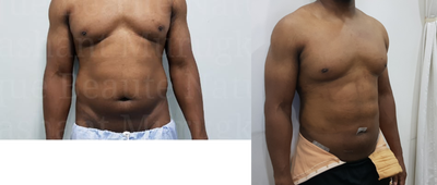 Abdominal Etching before and after photo