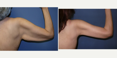 Arm Lift before and after photo