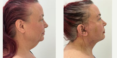 Deep Plane Facelift before and after photo