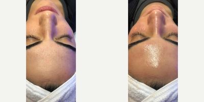 HydraFacial before and after photo