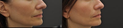 Juvederm before and after photo