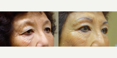 Restylane before and after photo
