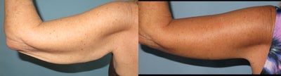 Arm Lift before and after photo
