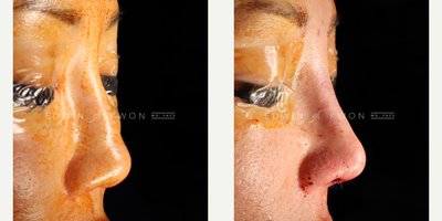 Asian Rhinoplasty before and after photo