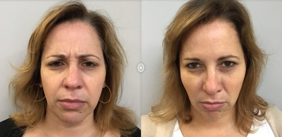 Botox before and after photo