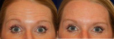 Botox before and after photo