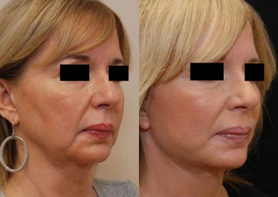 Contour Thread Lift before and after photo