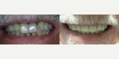 Dental Crown before and after photo