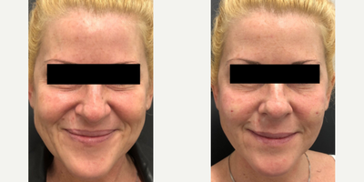 Dermal Fillers before and after photo