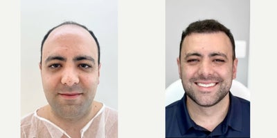FUE Hair Transplant before and after photo