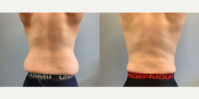 Liposuction before and after photo