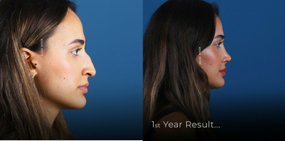Rhinoplasty before and after photo