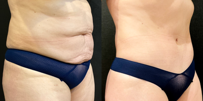 Tummy Tuck before and after photo